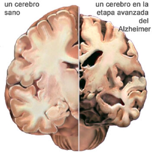 ALZHAIMER