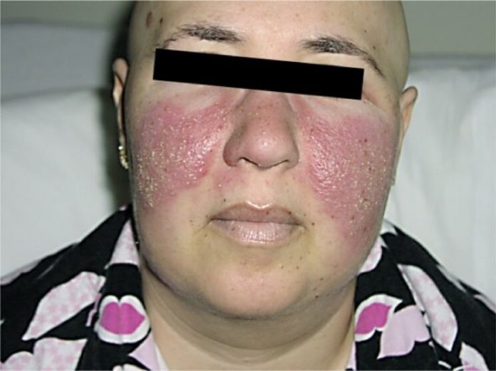 lupus