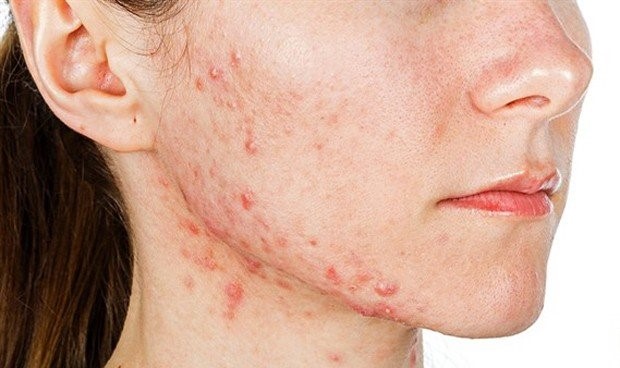 hidradenitis